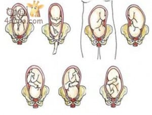 ماذا يحدث اذا لم يتخذ الجنين الوضع الطبيعى للولادة Fetus_postion_02-300x227