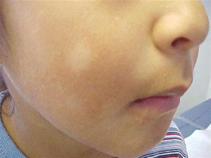 البقع البيضاء عند الأطفال أسبابها وطرق العلاج صحة الطفل فورنونو